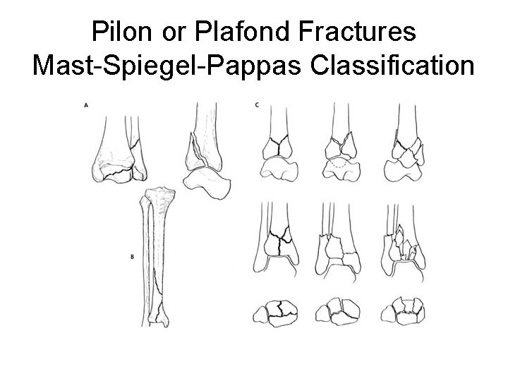 Pilon or Plafond Fractures Mast-Spiegel-Pappas Classification 