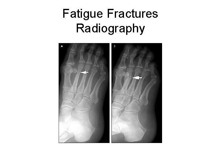 Fatigue Fractures Radiography 
