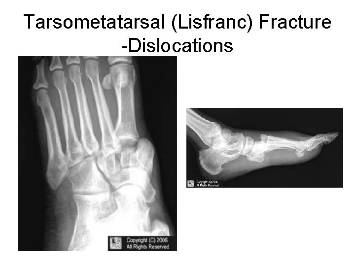 Tarsometatarsal (Lisfranc) Fracture -Dislocations 