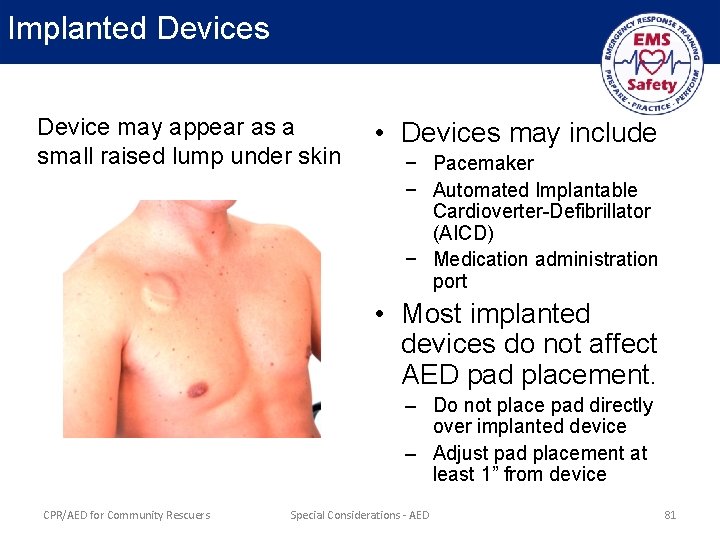 Implanted Devices Device may appear as a small raised lump under skin • Devices