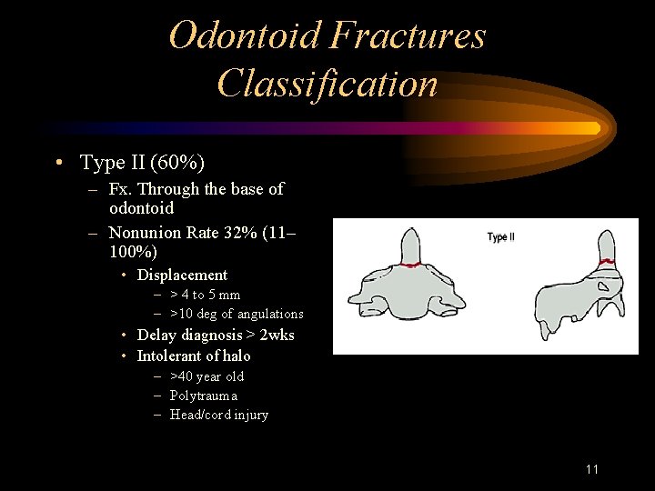 Odontoid Fractures Classification • Type II (60%) – Fx. Through the base of odontoid