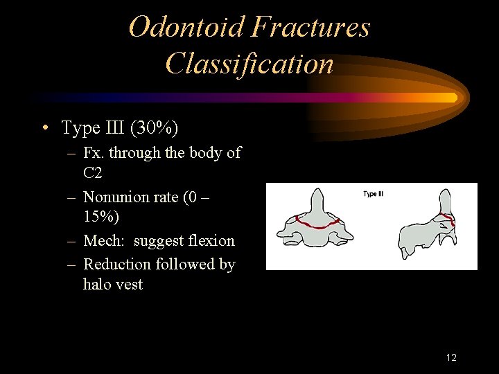 Odontoid Fractures Classification • Type III (30%) – Fx. through the body of C