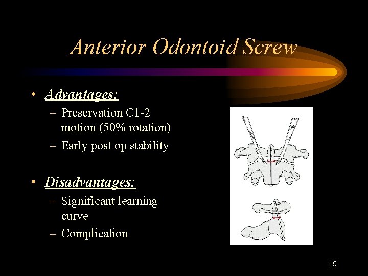 Anterior Odontoid Screw • Advantages: – Preservation C 1 -2 motion (50% rotation) –