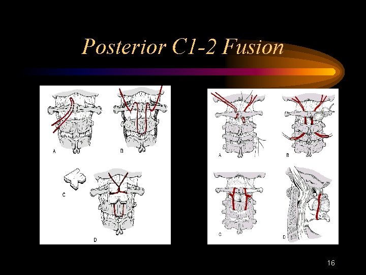 Posterior C 1 -2 Fusion 16 