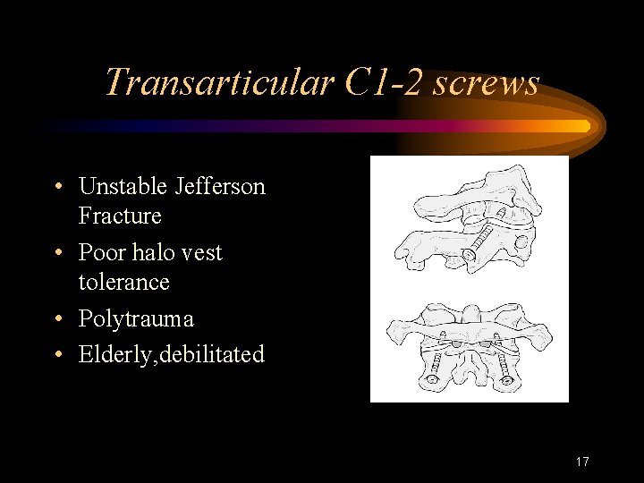 Transarticular C 1 -2 screws • Unstable Jefferson Fracture • Poor halo vest tolerance