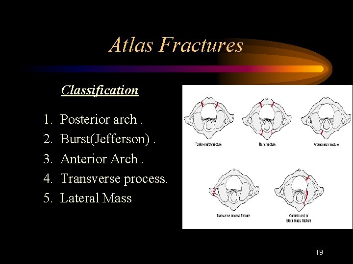 Atlas Fractures Classification 1. 2. 3. 4. 5. Posterior arch. Burst(Jefferson). Anterior Arch. Transverse