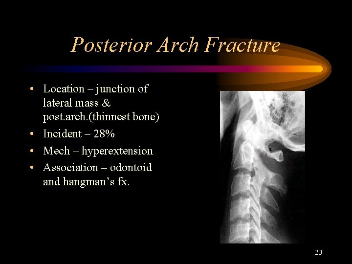 Posterior Arch Fracture • Location – junction of lateral mass & post. arch. (thinnest