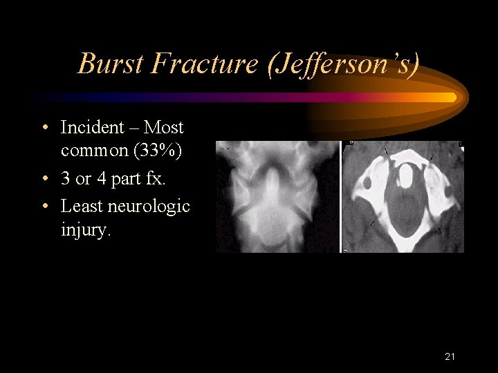 Burst Fracture (Jefferson’s) • Incident – Most common (33%) • 3 or 4 part