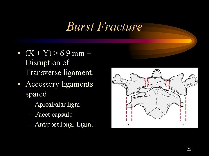 Burst Fracture • (X + Y) > 6. 9 mm = Disruption of Transverse