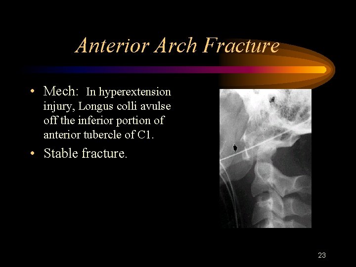 Anterior Arch Fracture • Mech: In hyperextension injury, Longus colli avulse off the inferior