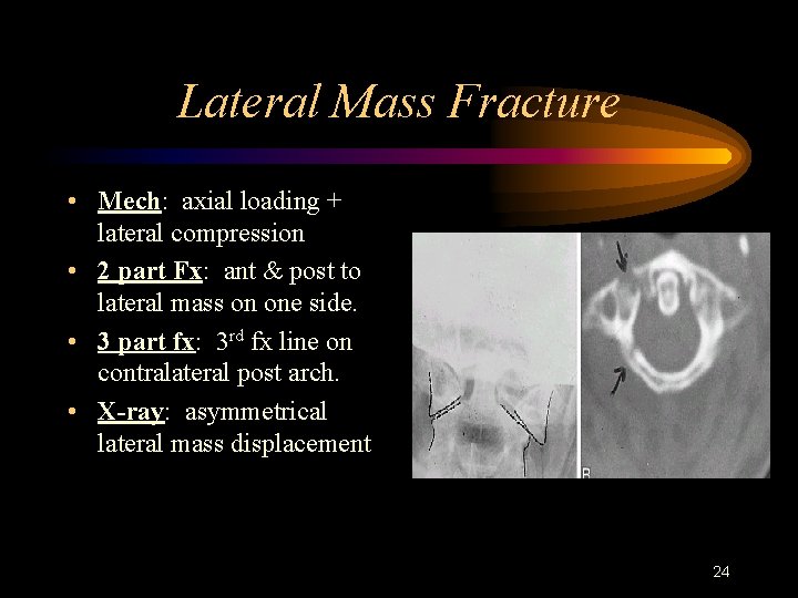 Lateral Mass Fracture • Mech: axial loading + lateral compression • 2 part Fx: