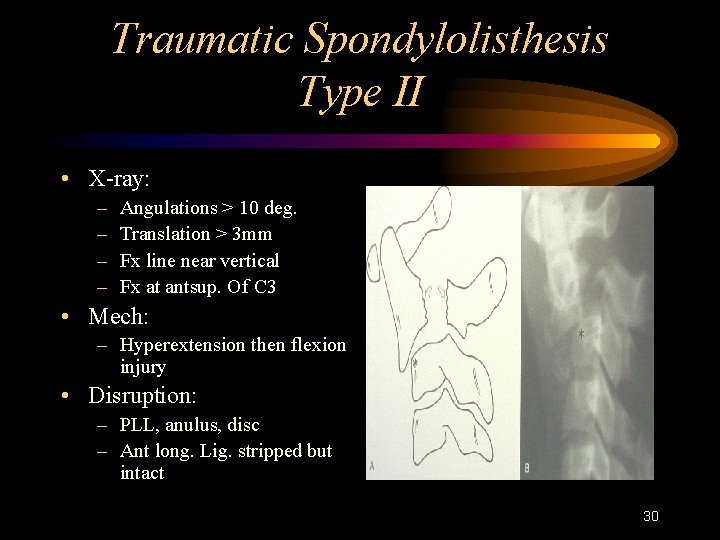 Traumatic Spondylolisthesis Type II • X-ray: – – Angulations > 10 deg. Translation >