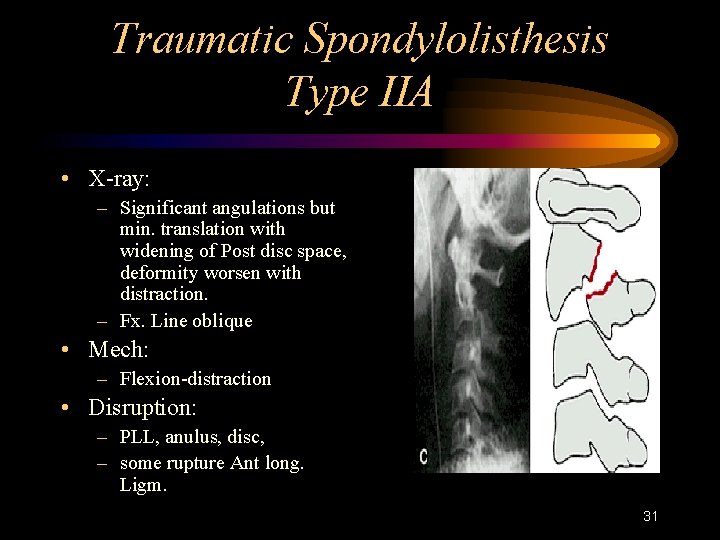 Traumatic Spondylolisthesis Type IIA • X-ray: – Significant angulations but min. translation with widening