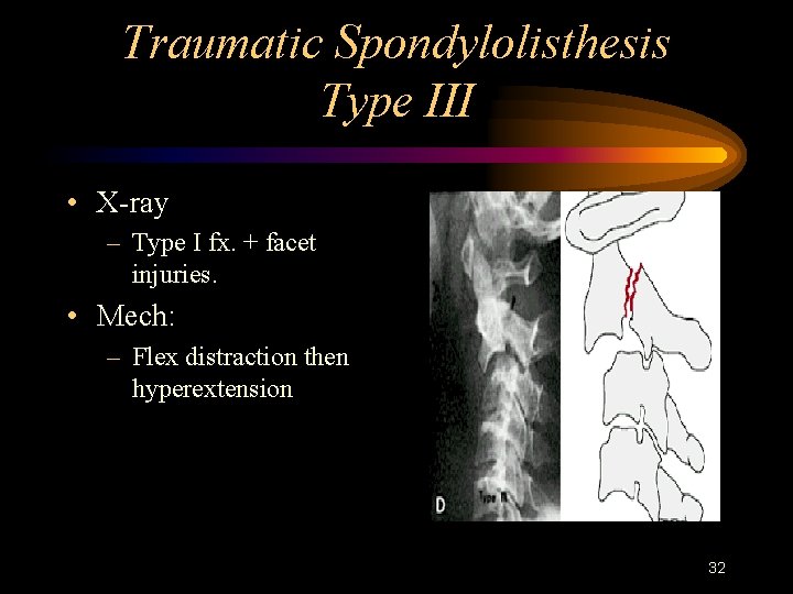 Traumatic Spondylolisthesis Type III • X-ray – Type I fx. + facet injuries. •