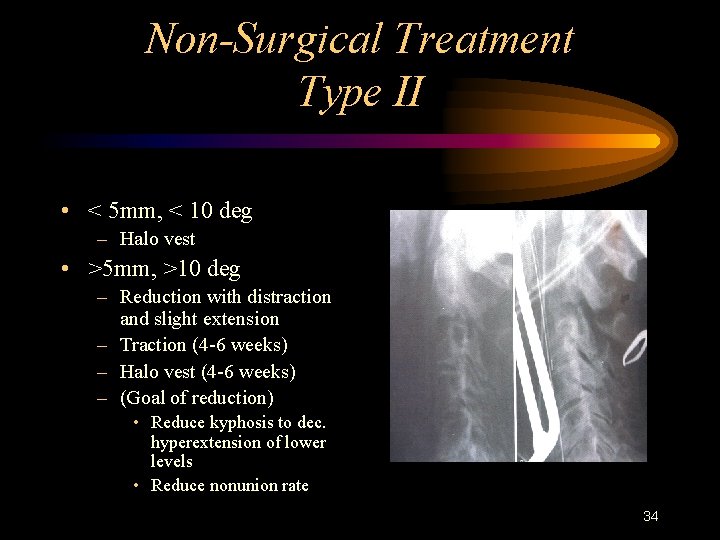 Non-Surgical Treatment Type II • < 5 mm, < 10 deg – Halo vest