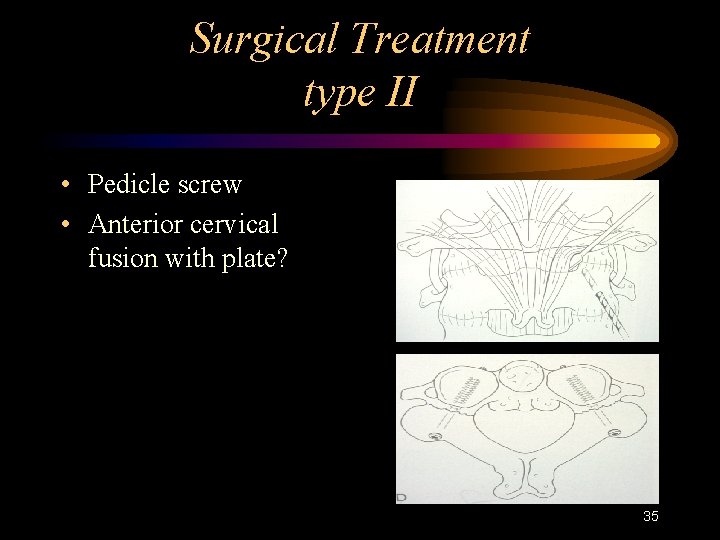 Surgical Treatment type II • Pedicle screw • Anterior cervical fusion with plate? 35