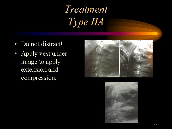 Treatment Type IIA • Do not distract! • Apply vest under image to apply