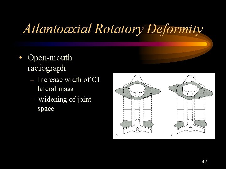 Atlantoaxial Rotatory Deformity • Open-mouth radiograph – Increase width of C 1 lateral mass