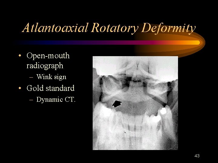 Atlantoaxial Rotatory Deformity • Open-mouth radiograph – Wink sign • Gold standard – Dynamic