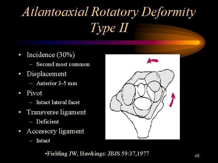 Atlantoaxial Rotatory Deformity Type II • Incidence (30%) – Second most common • Displacement