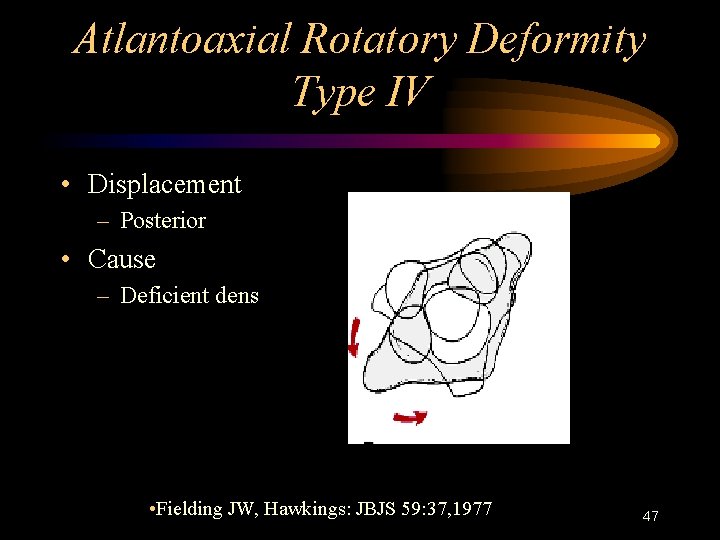 Atlantoaxial Rotatory Deformity Type IV • Displacement – Posterior • Cause – Deficient dens