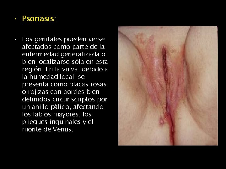  • Psoriasis: • Los genitales pueden verse afectados como parte de la enfermedad