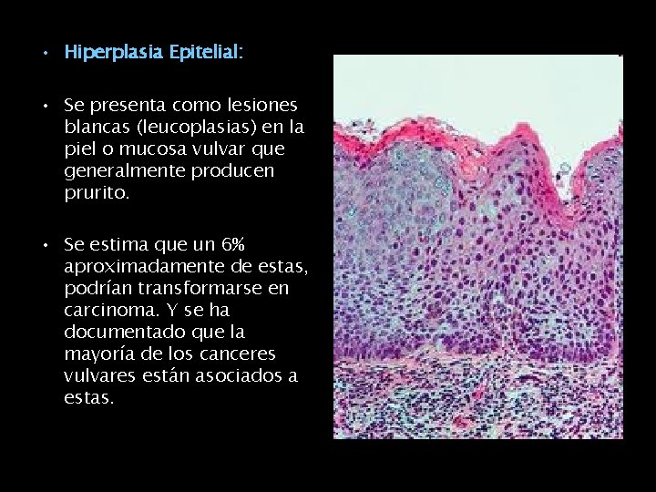  • Hiperplasia Epitelial: • Se presenta como lesiones blancas (leucoplasias) en la piel