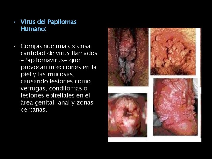  • Virus del Papilomas Humano: • Comprende una extensa cantidad de virus llamados