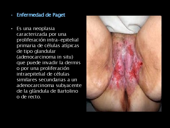  • Enfermedad de Paget • Es una neoplasia caracterizada por una proliferación intra-epitelial