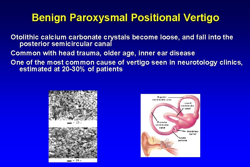 Benign Paroxysmal Positional Vertigo Otolithic calcium carbonate crystals become loose, and fall into the