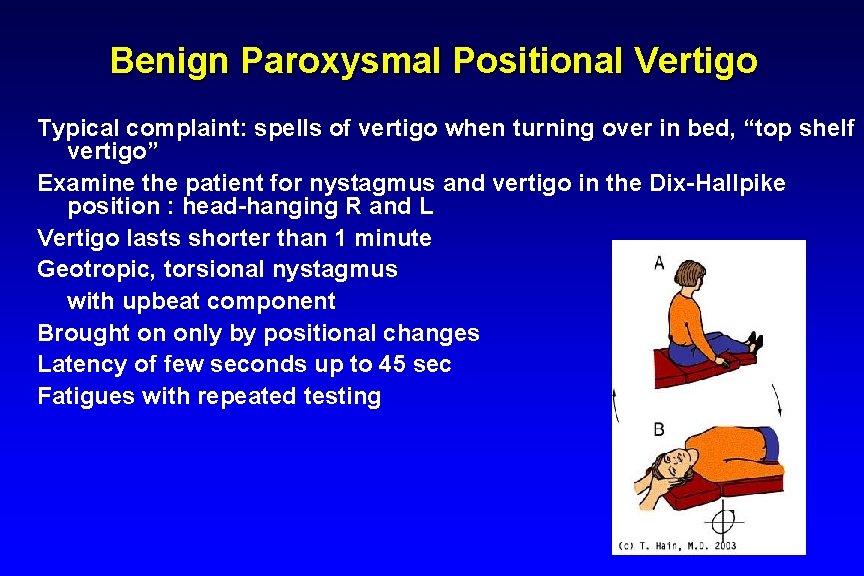 Benign Paroxysmal Positional Vertigo Typical complaint: spells of vertigo when turning over in bed,