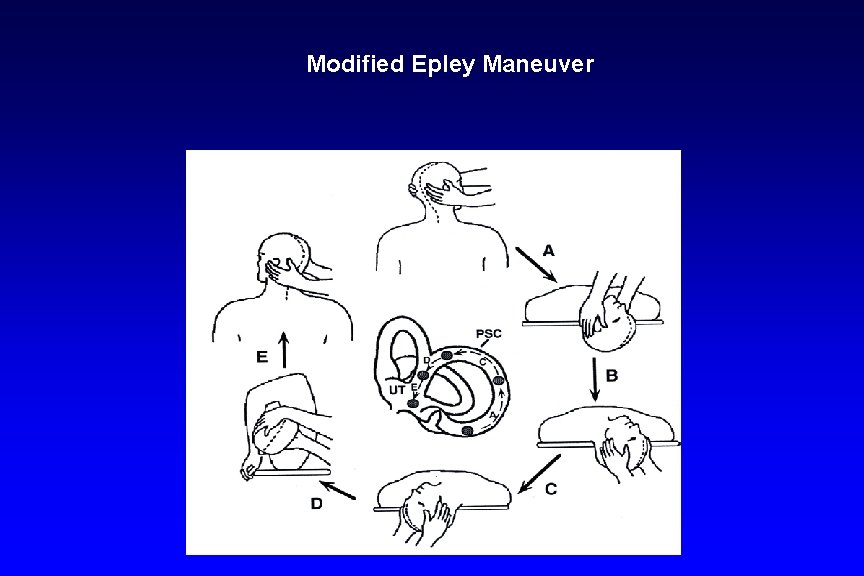 Modified Epley Maneuver 