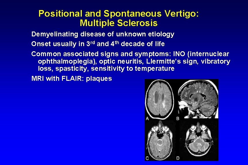 Positional and Spontaneous Vertigo: Multiple Sclerosis Demyelinating disease of unknown etiology Onset usually in