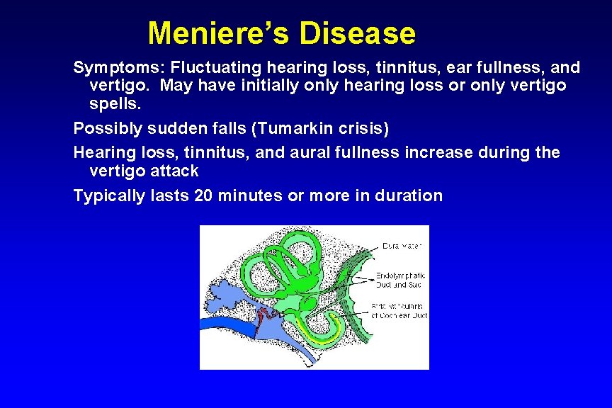 Meniere’s Disease Symptoms: Fluctuating hearing loss, tinnitus, ear fullness, and vertigo. May have initially