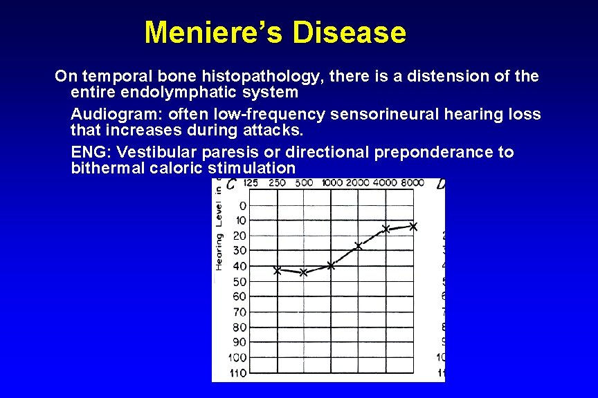 Meniere’s Disease On temporal bone histopathology, there is a distension of the entire endolymphatic