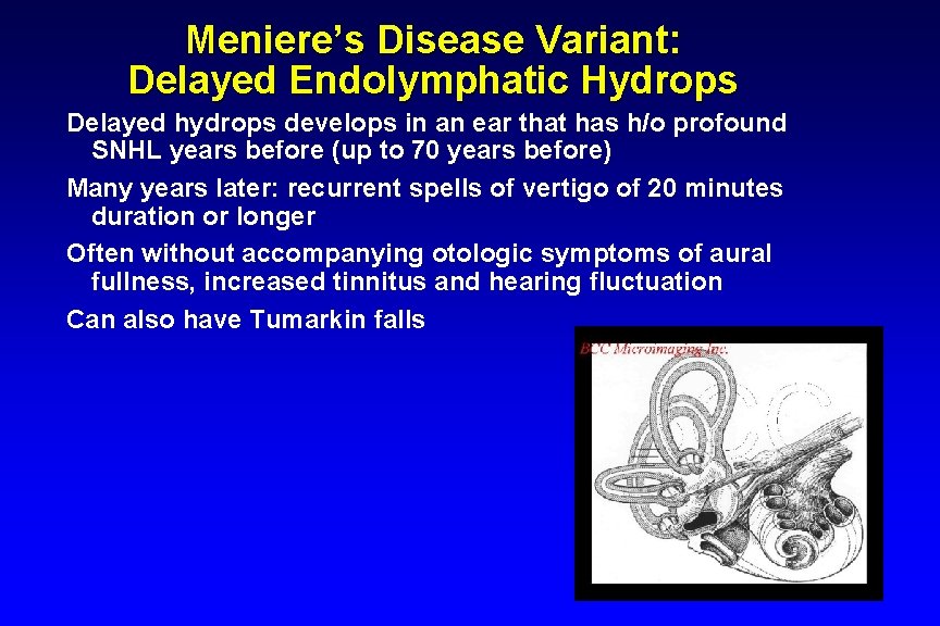 Meniere’s Disease Variant: Delayed Endolymphatic Hydrops Delayed hydrops develops in an ear that has