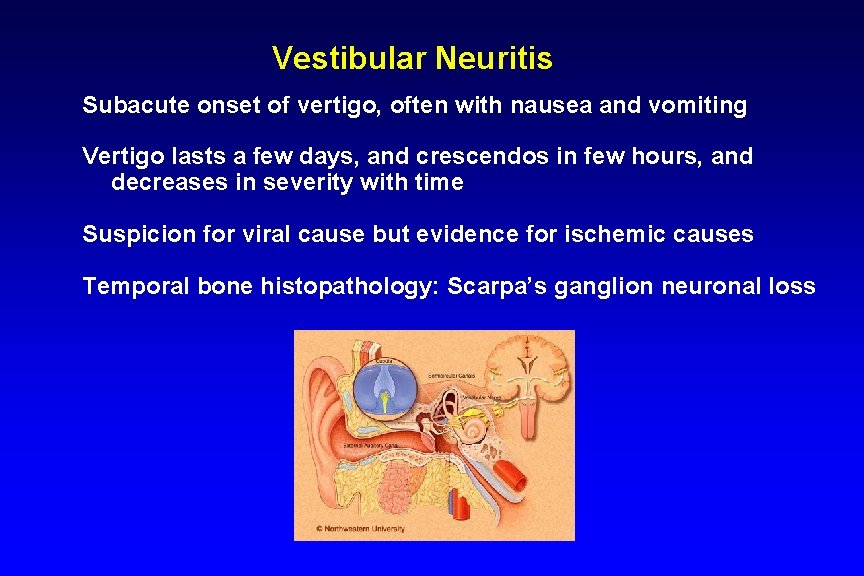 Vestibular Neuritis Subacute onset of vertigo, often with nausea and vomiting Vertigo lasts a