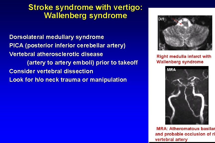 Stroke syndrome with vertigo: Wallenberg syndrome Dorsolateral medullary syndrome PICA (posterior inferior cerebellar artery)