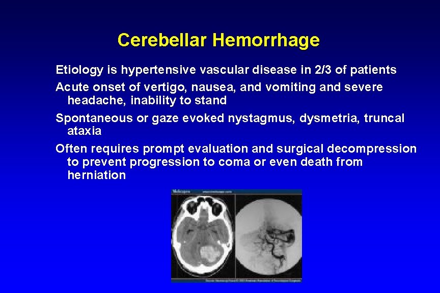 Cerebellar Hemorrhage Etiology is hypertensive vascular disease in 2/3 of patients Acute onset of