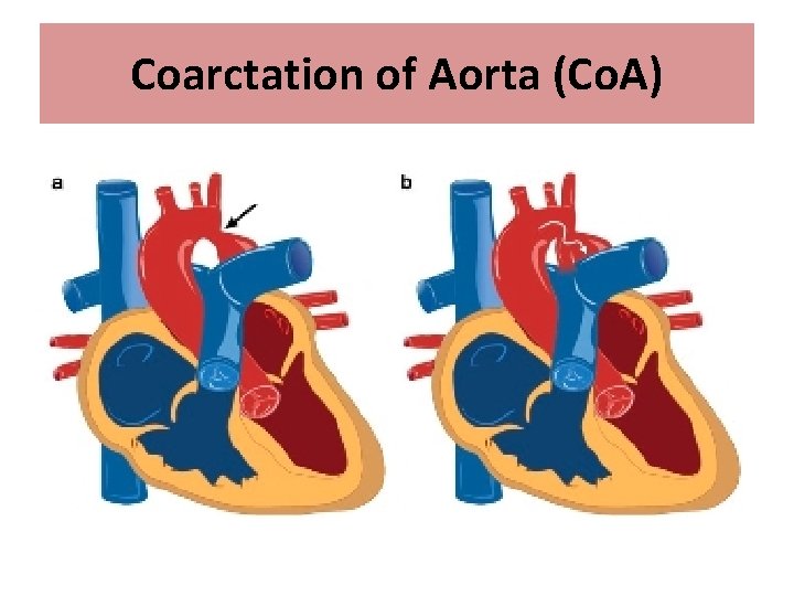 Coarctation of Aorta (Co. A) 