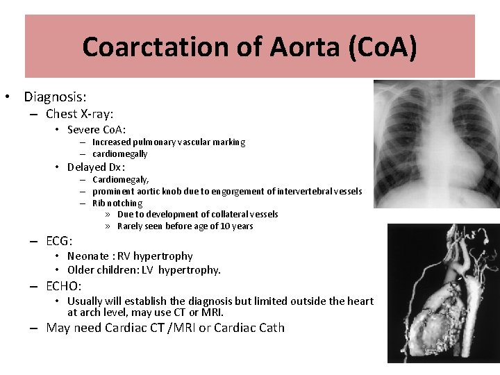 Coarctation of Aorta (Co. A) • Diagnosis: – Chest X-ray: • Severe Co. A: