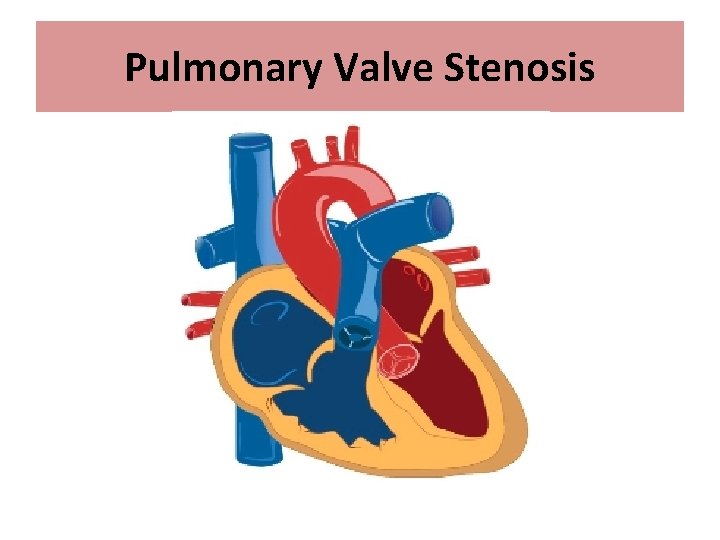 Pulmonary Valve Stenosis 