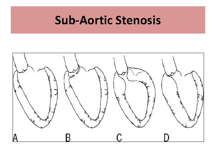 Sub-Aortic Stenosis 