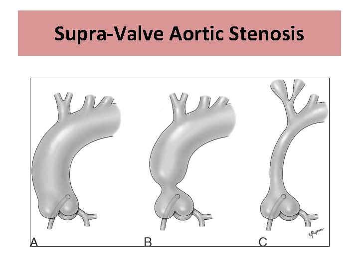 Supra-Valve Aortic Stenosis 