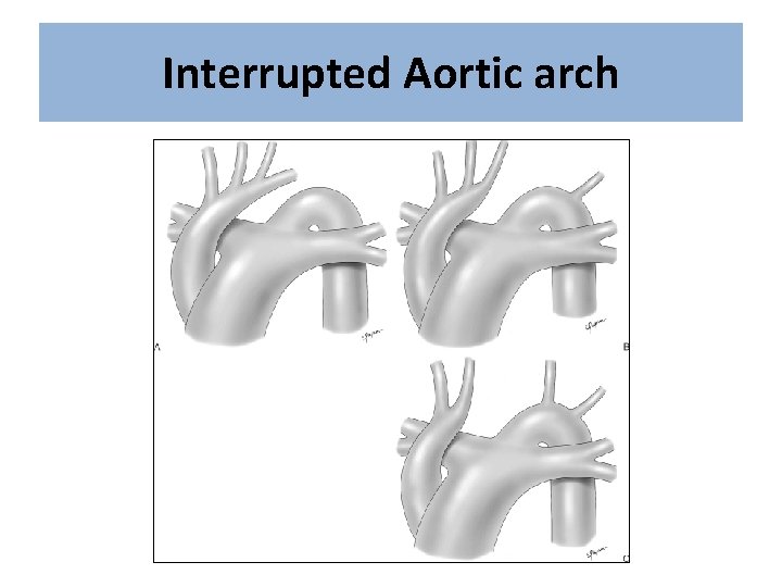 Interrupted Aortic arch 