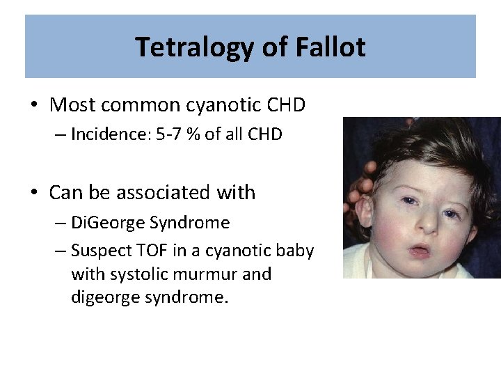 Tetralogy of Fallot • Most common cyanotic CHD – Incidence: 5 -7 % of