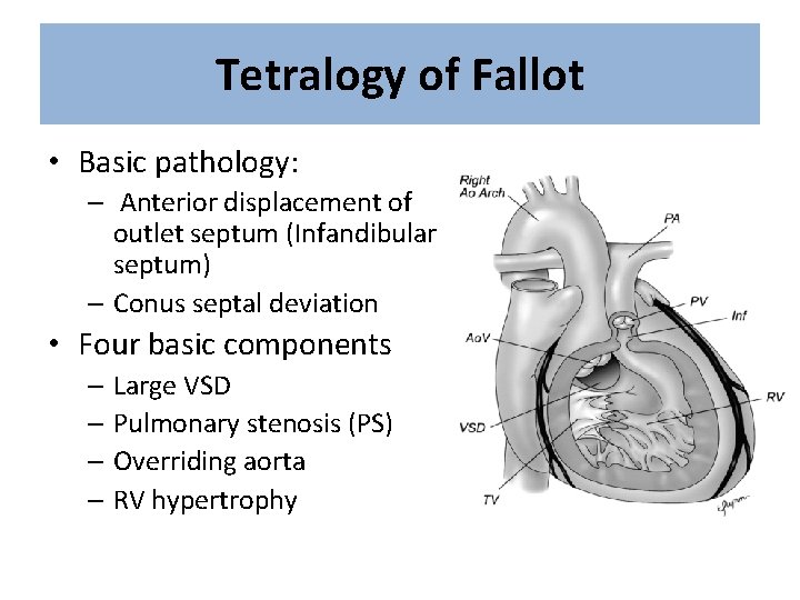 Tetralogy of Fallot • Basic pathology: – Anterior displacement of outlet septum (Infandibular septum)