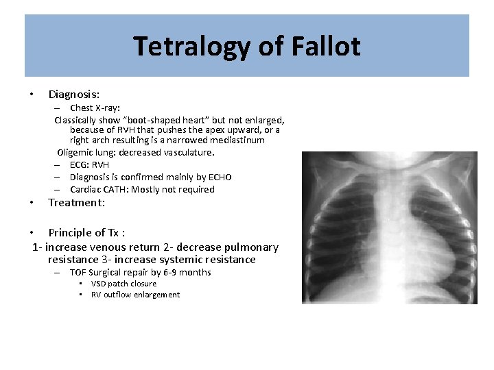 Tetralogy of Fallot • Diagnosis: – Chest X-ray: Classically show “boot-shaped heart” but not