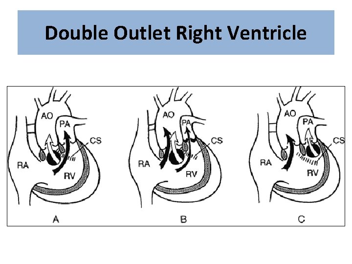 Double Outlet Right Ventricle 
