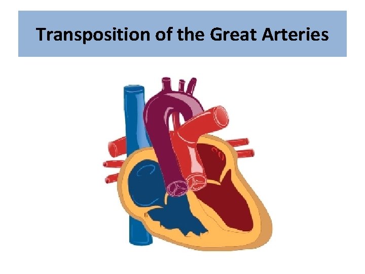 Transposition of the Great Arteries 